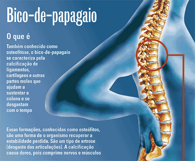 Bico de papagaio ou osteófito na coluna vertebral - Médico Jorge ...