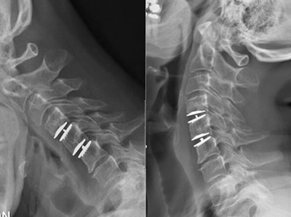 Artroplastia de Disco Cervical: Vantagens e Benefícios da Prótese de Disco